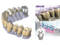 歯科用CADソフト『exocad』